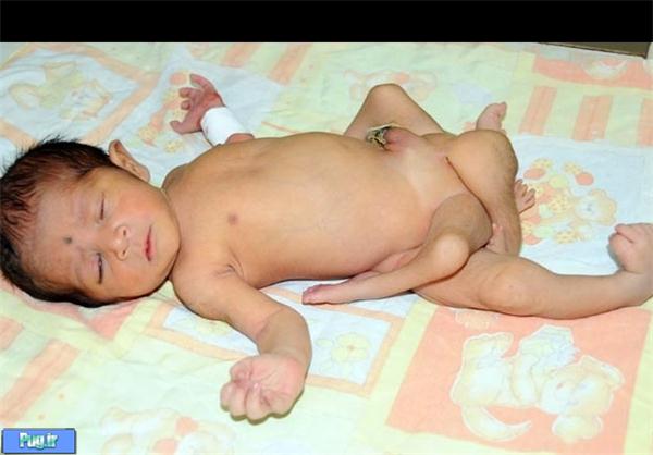 4 پای نوزاد از بدنش جدا شد+عکس