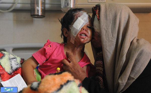 تصاویر:اسیدپاشی پدر بر روی همسر و دخترش