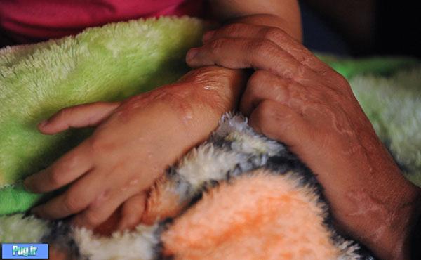 تصاویر:اسیدپاشی پدر بر روی همسر و دخترش