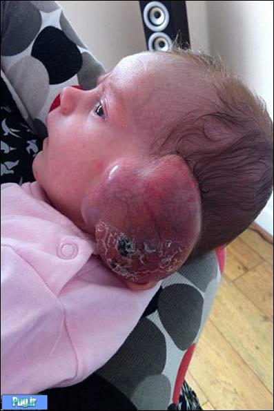 سرطان نادر و وحشتناک نوزاد 4ماهه! + عکس