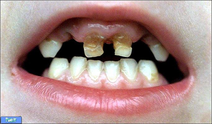 استفاده آمریکا از ماده سمی فلوراید استفاده آمریکا از ماده سمی فلوراید