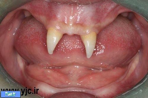پسری با دندان هایی شبیه خون آشام!! + عکس  