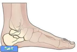 ارتباط چاقی و استعداد ابتلا به خار پاشنه 