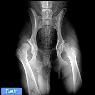 دیسپلازی هیپ در سگ ها (Hip Dysplasia)